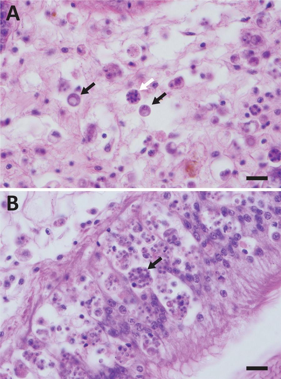 Panel A (top) shows the original form of the Dermo parasite {em}Perkinsus marinus{/em}, with black arrows indicating typical Dermo cells and the white arrow a dividing form, all infecting connective tissues deep inside an oyster. Panel B shows the new form of the parasite, much smaller, with the arrow indicating a mass of dozens of Dermo cells inside a single oyster blood cell, and primarily infecting the lining of the stomach and gut. © R. Carnegie/VIMS.