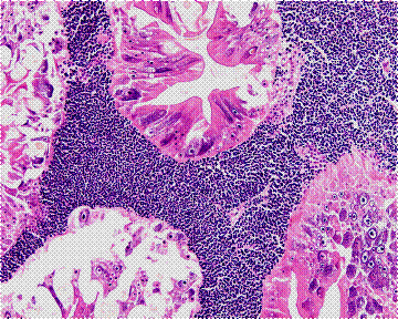 Hepatopancreas infected